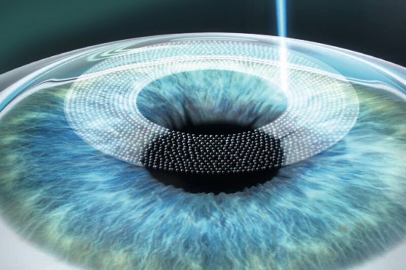 Femtolasik - Refractive surgery with femtosecond laser in Bogotá