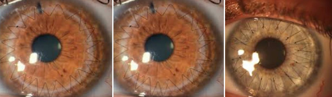 Specialized corneal transplant surgery